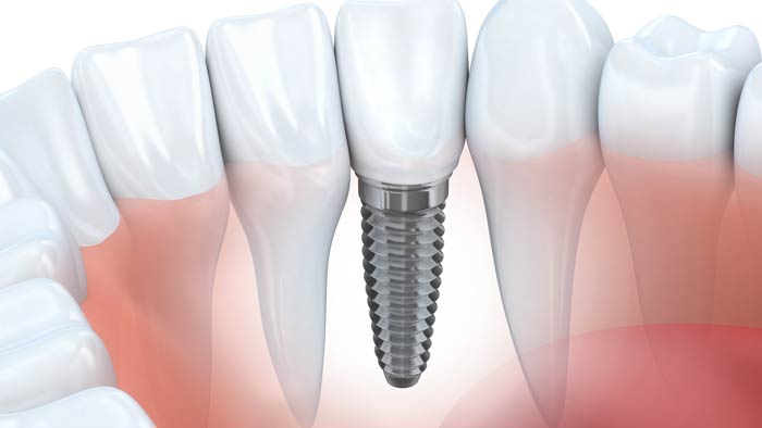 Dental Implant Dentist Wyoming, MI